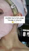 درمان جوش های صورت و دلیلش جوش ها و زیبایی مطلق 