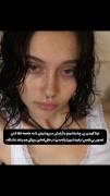 زیبایی گودی زیر چشم///////////